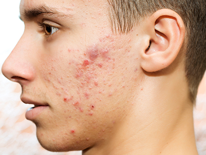 Acne