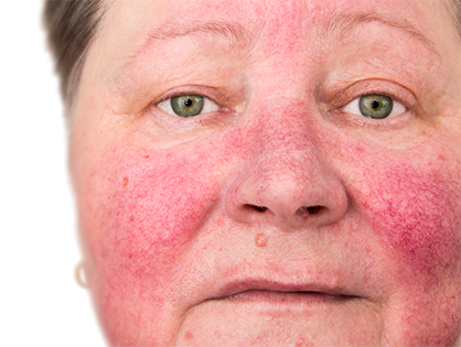 Rosacea