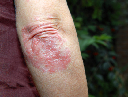 Dull skin (solar elastosis)